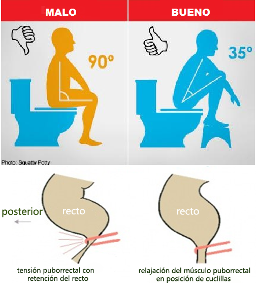 Estreñimiento y postura de defecación - Impulsa Fisioterapia