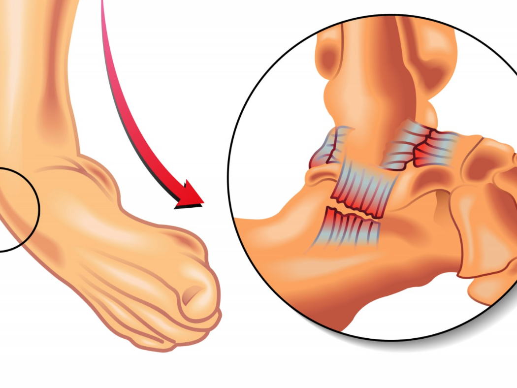 esguince de tobillo