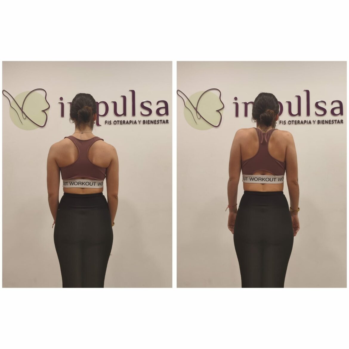 La Escápula y su Importancia en la Salud del Hombro - Impulsa Fisioterapia